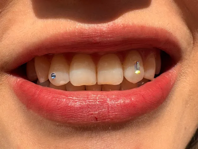 Sonrisa con un cristal redondo azul y otro rectangular en los incisivos laterales